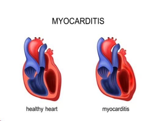 Myocarditis: Heart muscle inflammation.