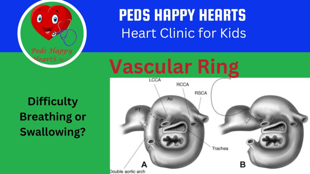 Link to vascular ring video