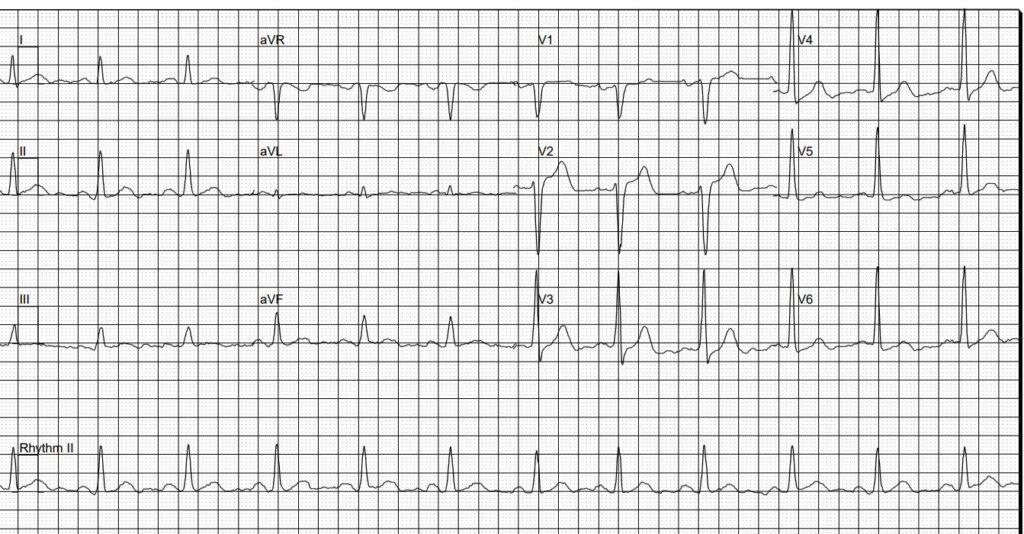 Abnormal electrocardiogram