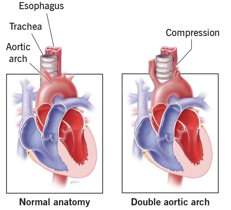 Double aortic arch